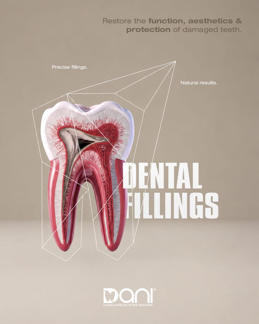 Dental Fillings